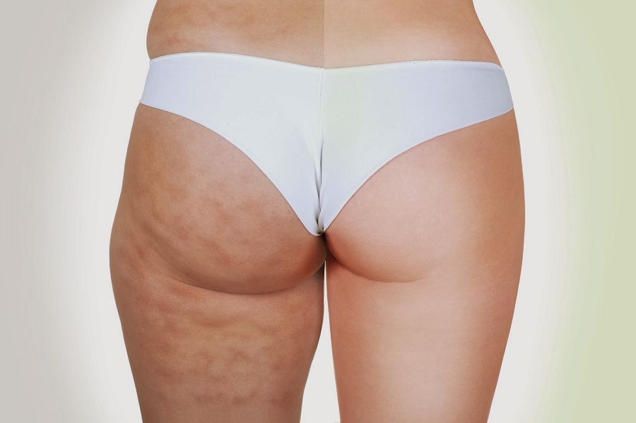 Natural Cellulite Treatments For You