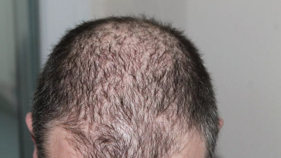 Shedding after a Hair Transplant is Common Phenomenon