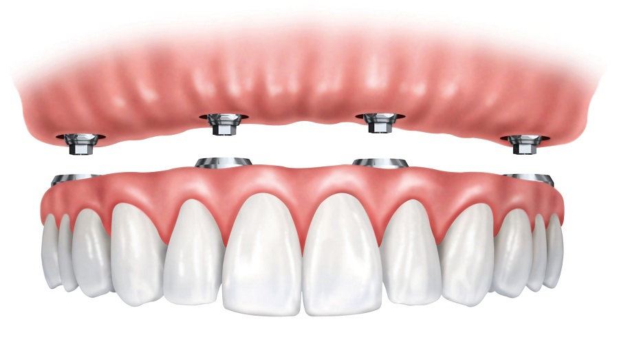 When Do You Need Mini Implant Dentures?
