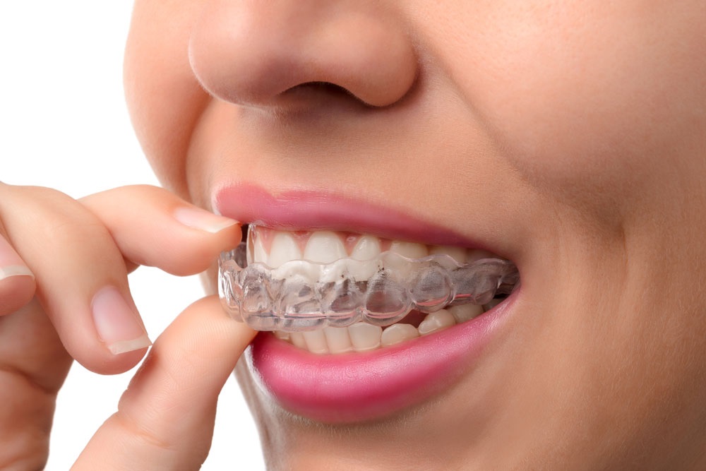 Invisalign: The Most Easy & Successful Way to Straighten Crooked Teeth