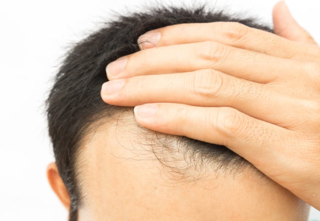 Why Hair Transplant is a Safe and Effective Hair Growth Procedure