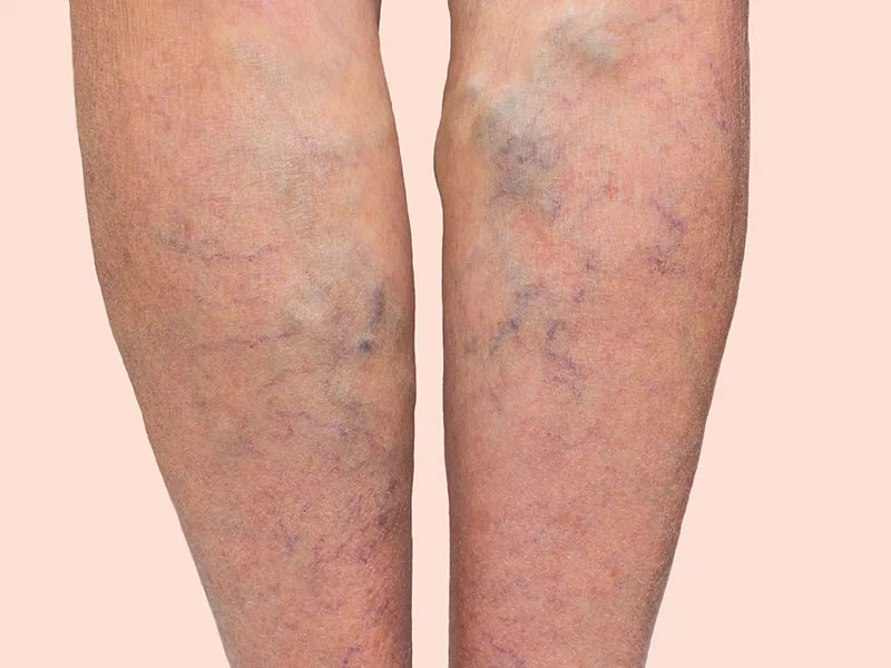 What is Varicose Veins and what is the treatment for this
