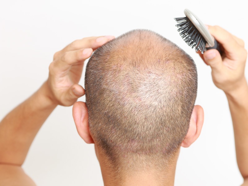Do Hair Transplants Have Any Side Effects?