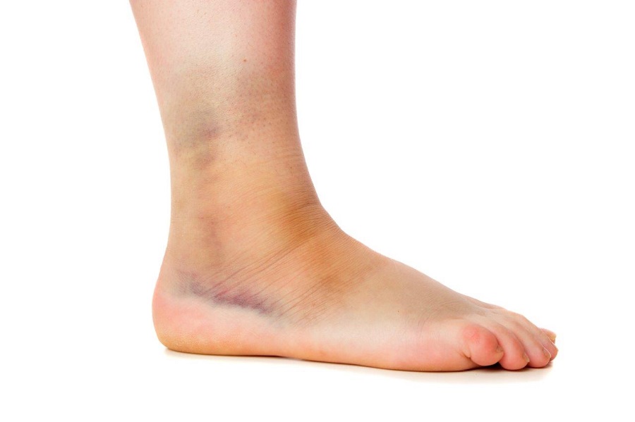 Common Foot or Ankle Injuries and What to Do with Them