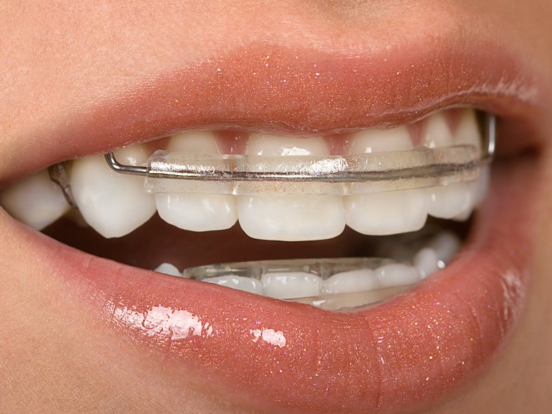 Few Ways How Invisible Braces Can Be Of Great Help!
