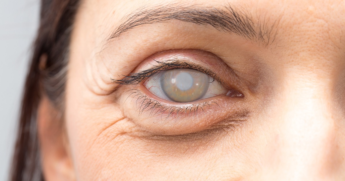 What is cataract surgery and who should get it?