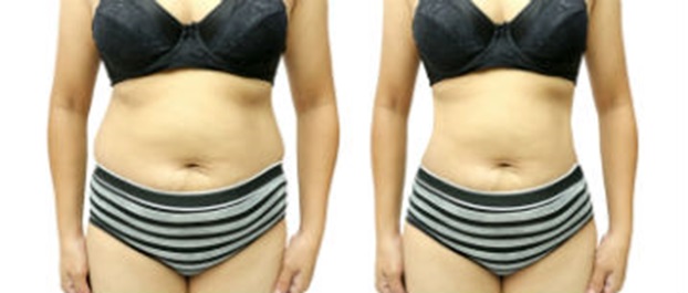 Quickly Lose Weight With Modern Liposuction