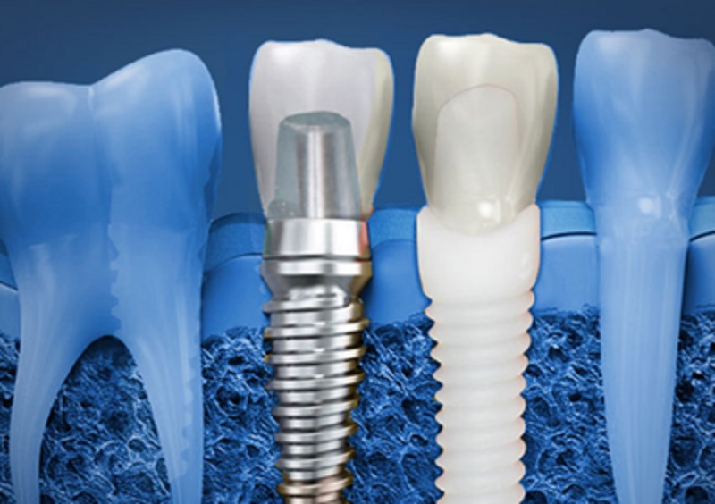 Know the Procedure for Dental Implants in Australia!