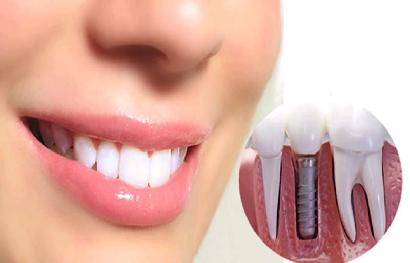 Restore Your Smile With Multiple Dental Implants!
