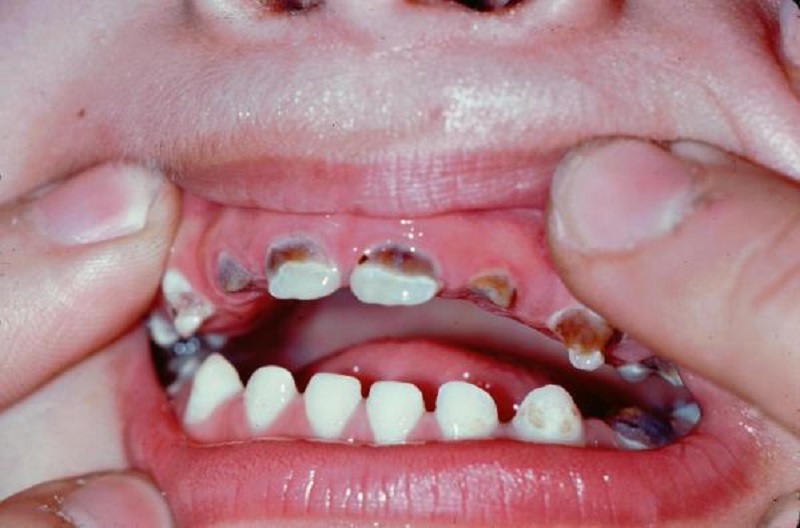 Rampant caries in various age groups and treatment