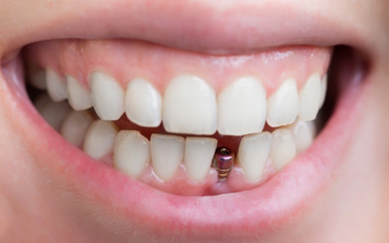 DENTAL IMPLANTS CAN BOOST CONFIDENCE & SELF-ESTEEM