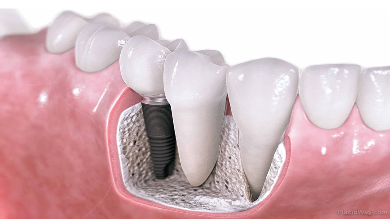 Opt for a Single Dental Implant Makes your appearance better