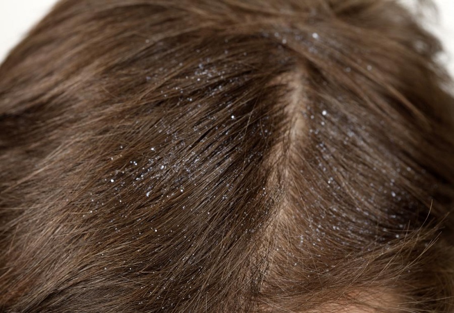 Signs you have Dandruff