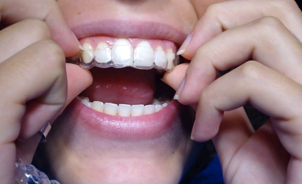 What Are The Factors That Determine The Invisible Braces Cost In Sydney?