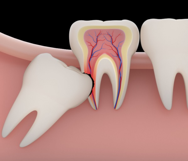 All about Dry Socket after Wisdom Teeth Removal