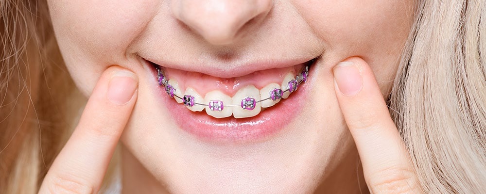 Foods You Can Eat With Braces