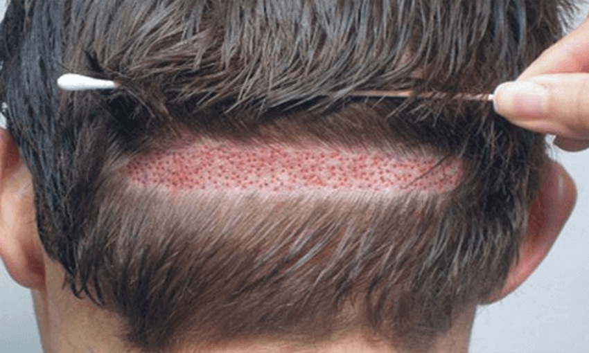 Factors that Affect the Cost of Hair Transplant Surgery