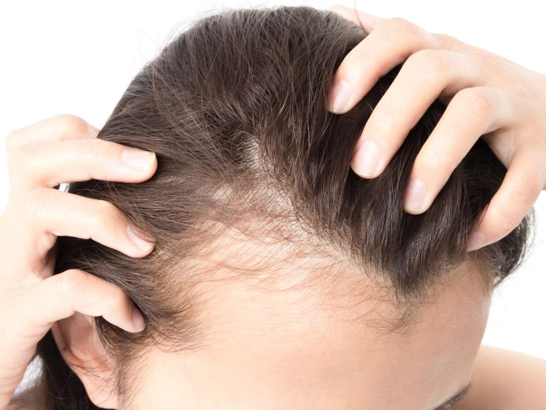 How to Regrow Hair Naturally?