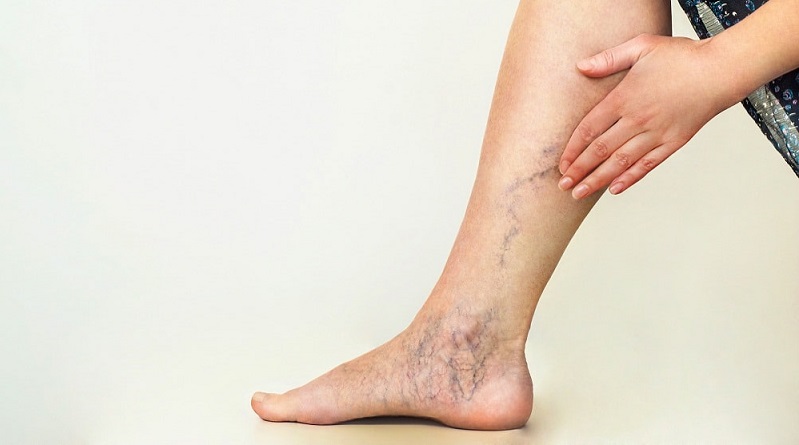 What Are the Varicose Veins and How Can They Be Treated