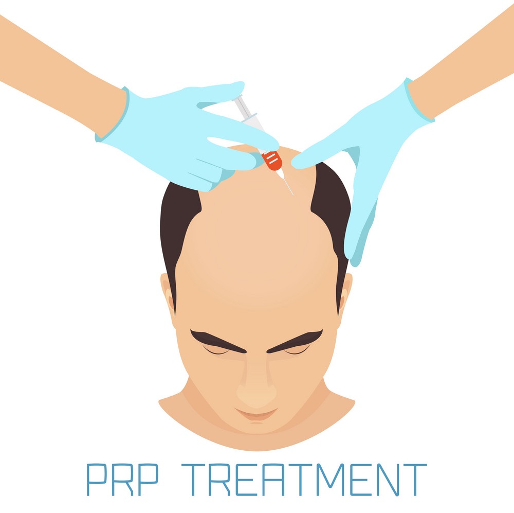 Things one must know before PRP Hair Treatments!