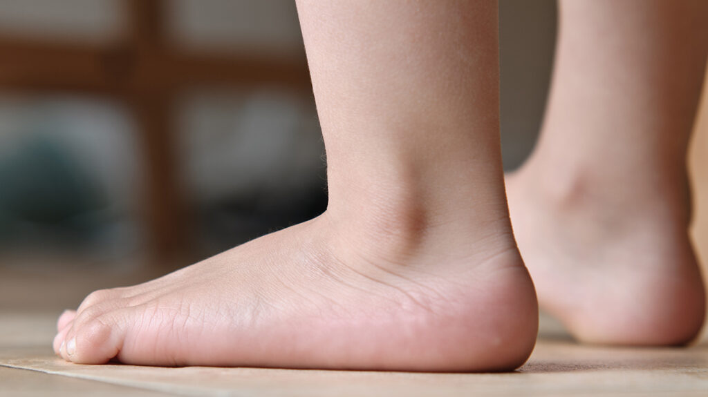 5 Potential Causes of Your Flat Feet