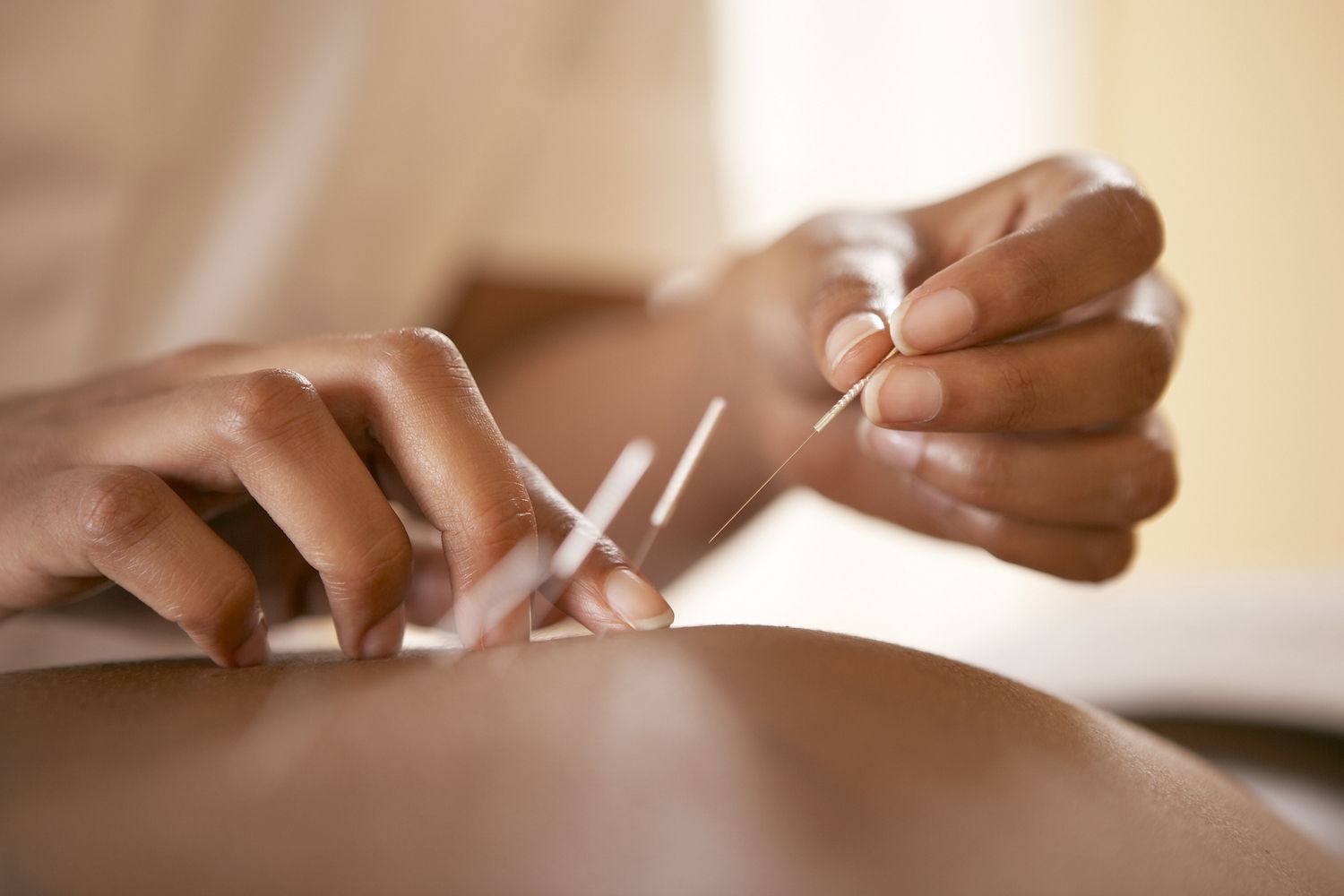 A Closer Look into Acupuncture