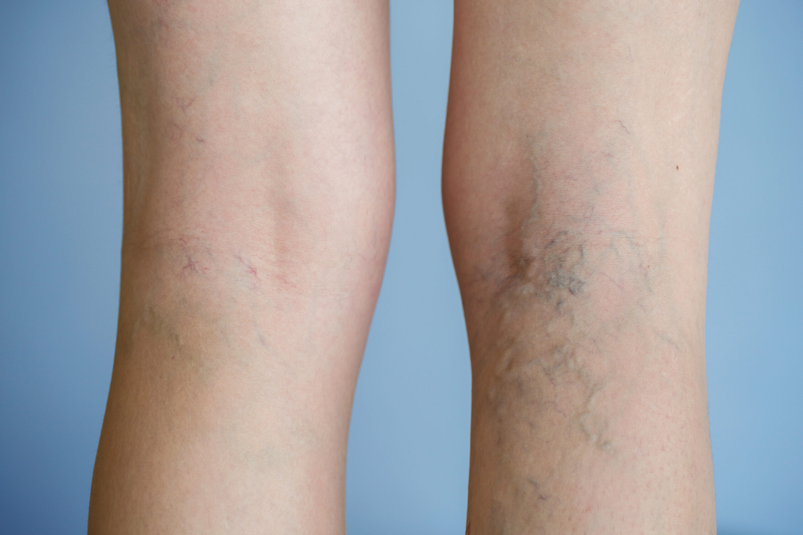 Varicose Veins: Top 5 Home Remedies