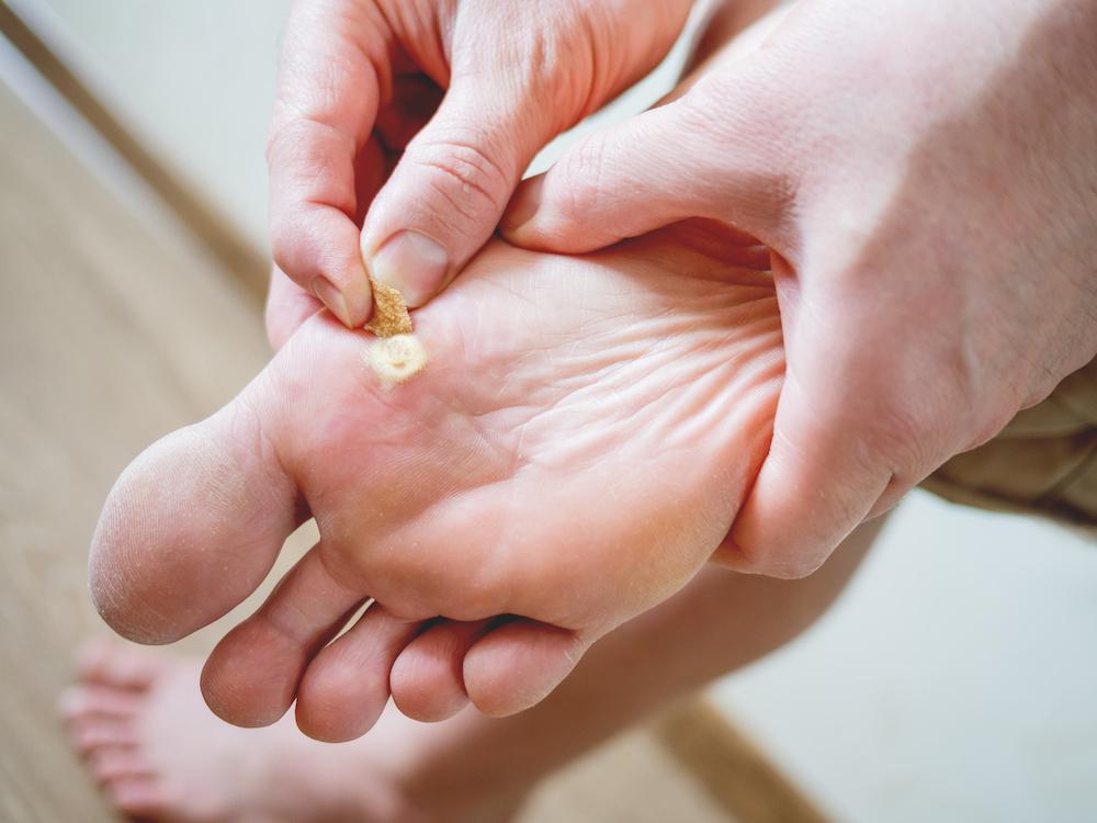 What Foot Warts Entails