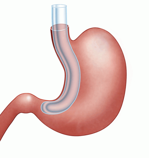 5 Laparoscopic Sleeve Gastrectomy Advantages