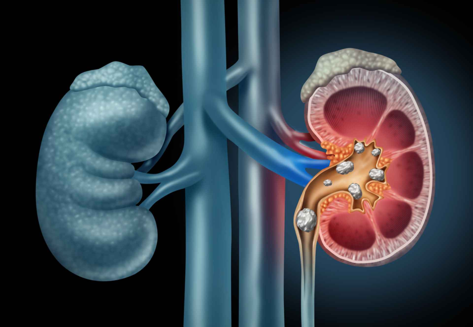 Effective Tips to Reduce Your Risk of Chronic Kidney Disease