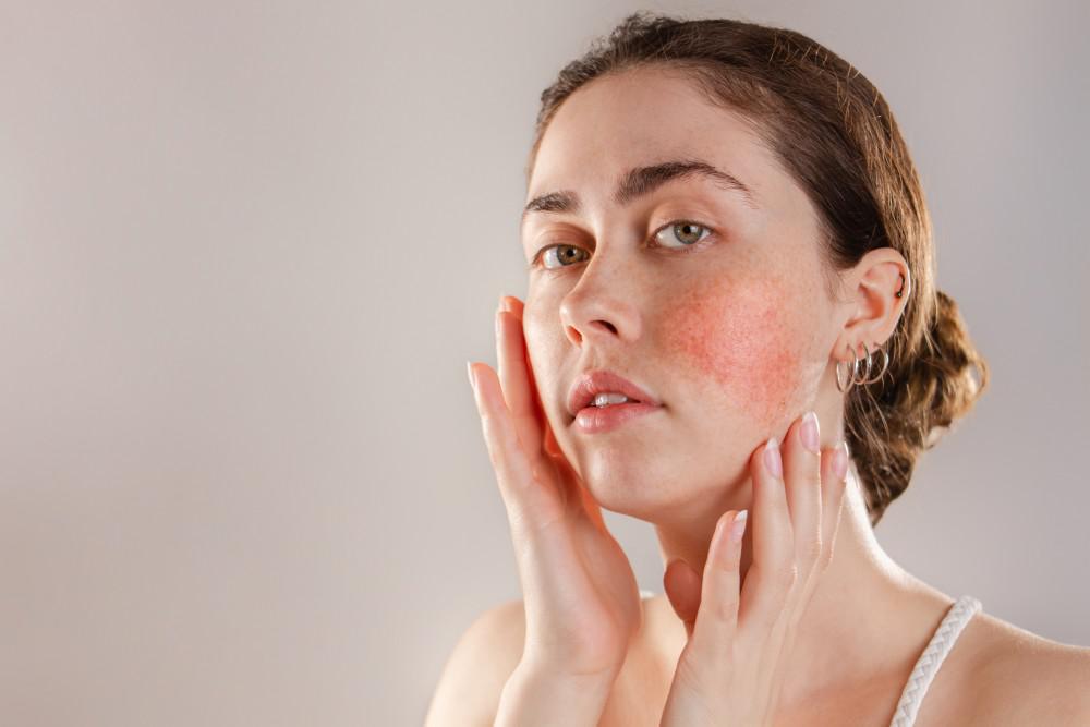 Tips To Prevent Rosacea Flare-Ups