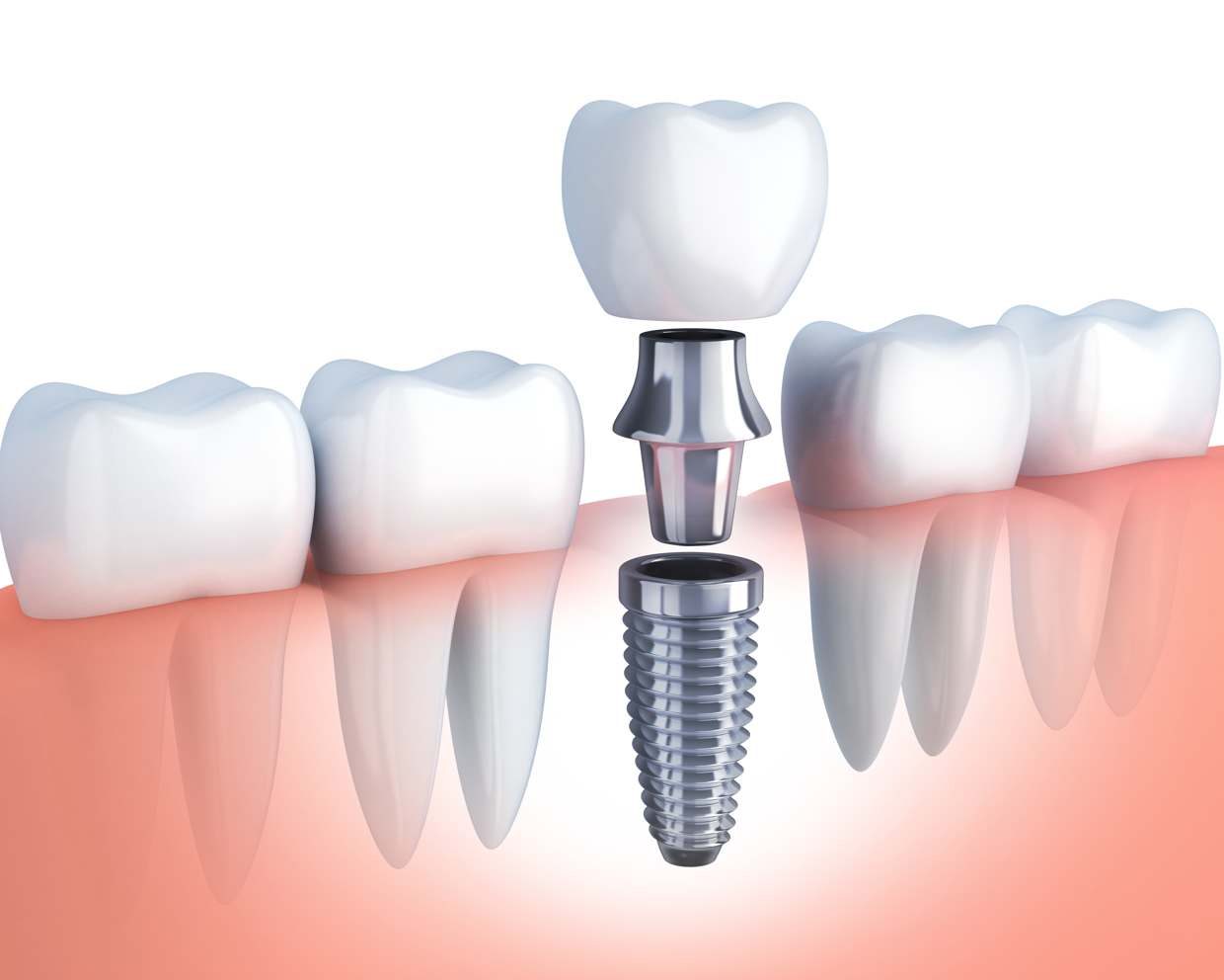 Crucial Facts That Will Help You Understand the Dental Implants