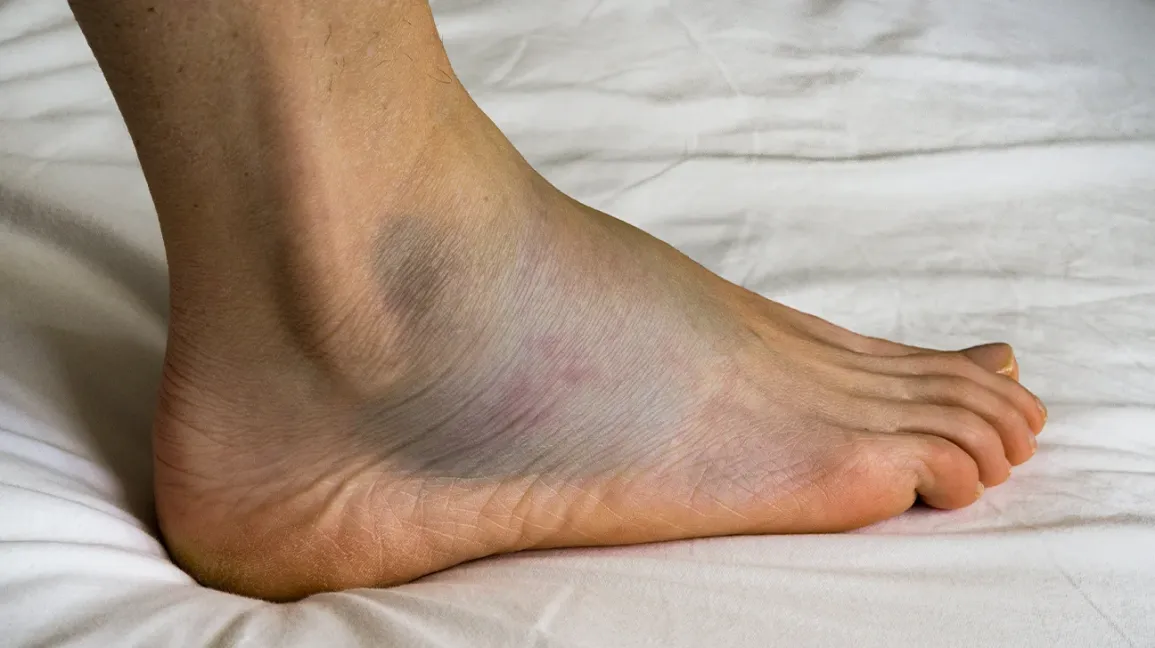 Causes and Treatment Options for Leg Swelling