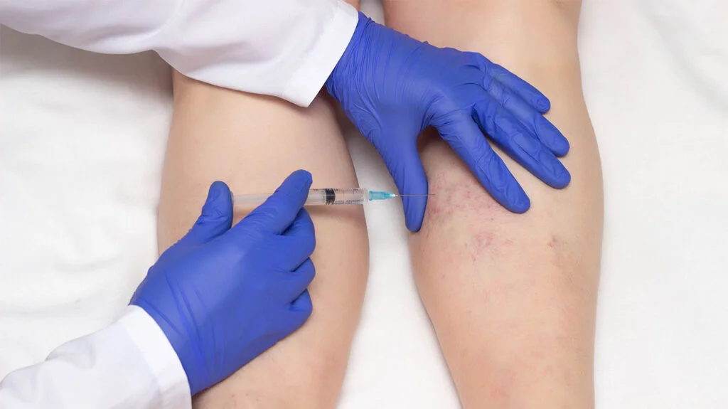 Check this simplified overview of sclerotherapy treatment
