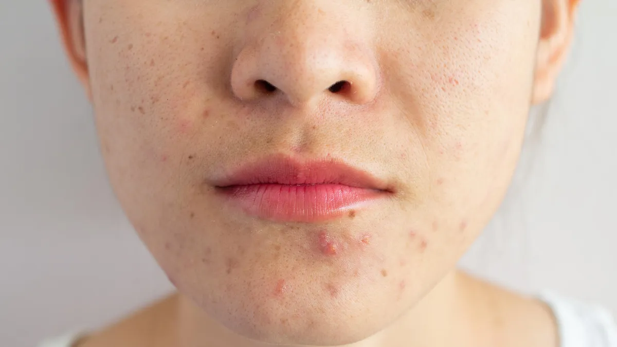 The Best Way to Get Rid of Acne