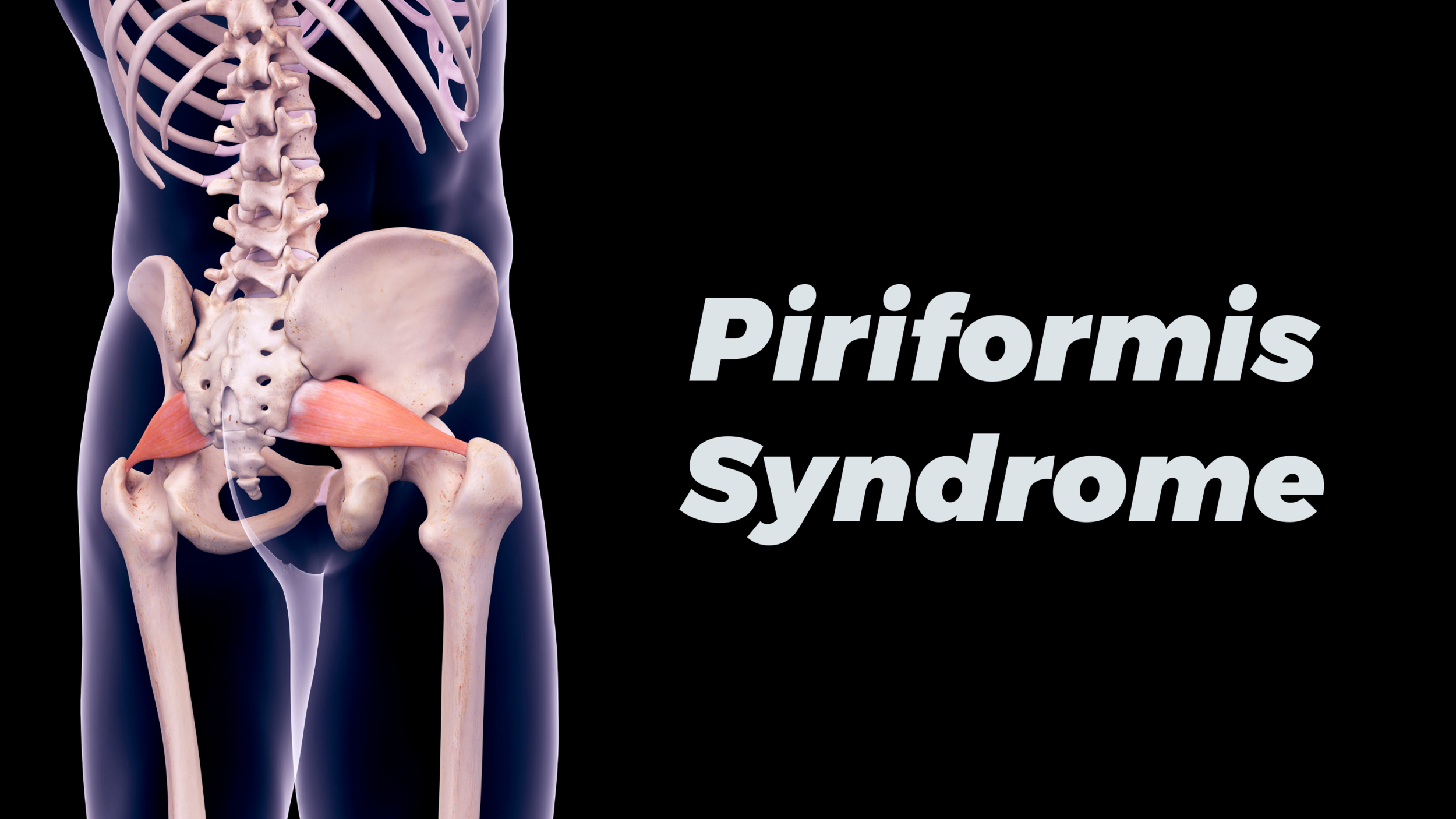 5 Effective Remedies for Piriformis Syndrome