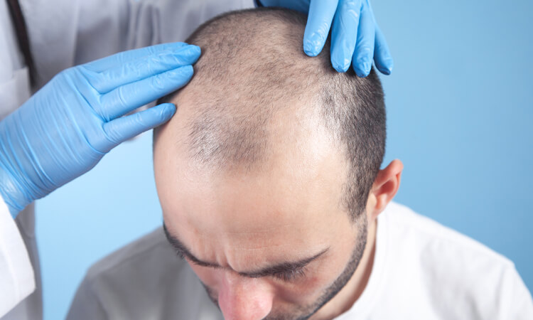 5 Benefits of Undergoing a Hair Transplant Surgery
