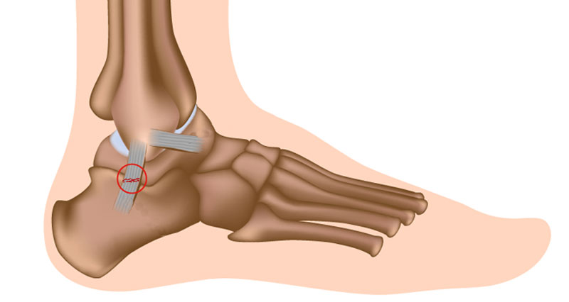 What Causes a Sprain?