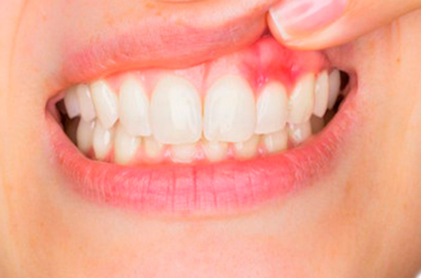 Gum Disease -Prevention And Treatment