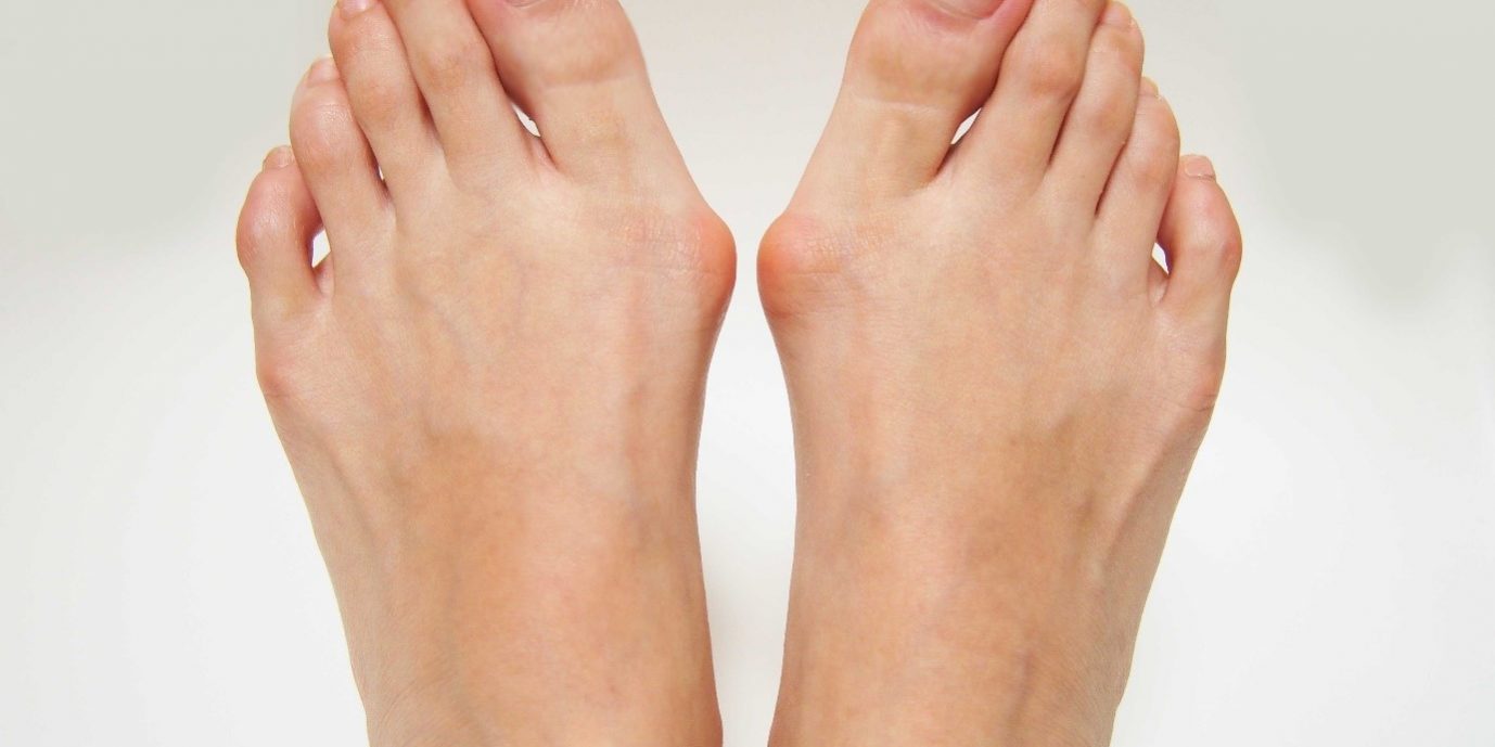 Signs You Should See a Podiatrist for Bunion Treatment