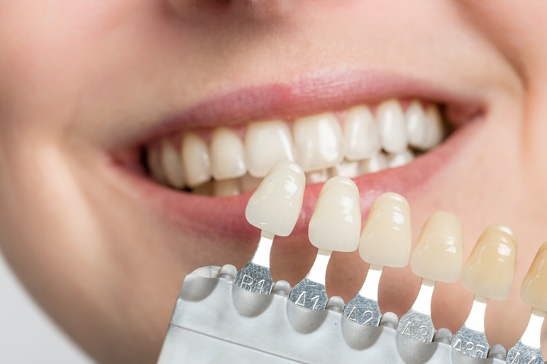Can We Whiten Our Dental Veneers?
