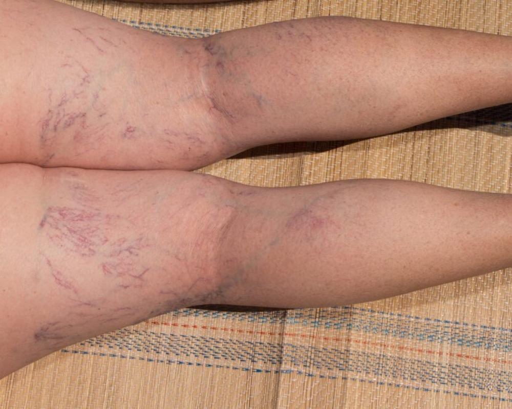 What Varicose Vein Ultrasound Can Tell You