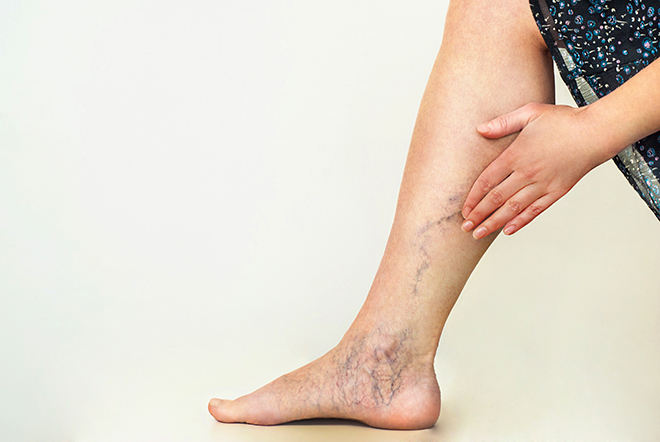How Do You Treat Swollen Legs From Varicose Veins? 