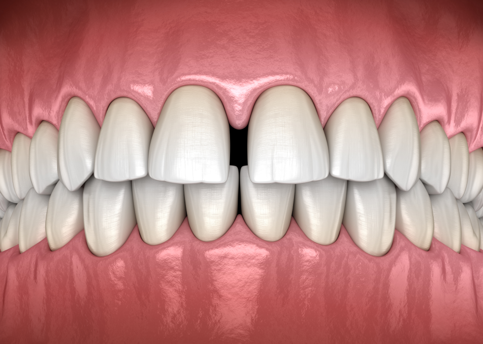 Every Thing You Need to Know About Diastema