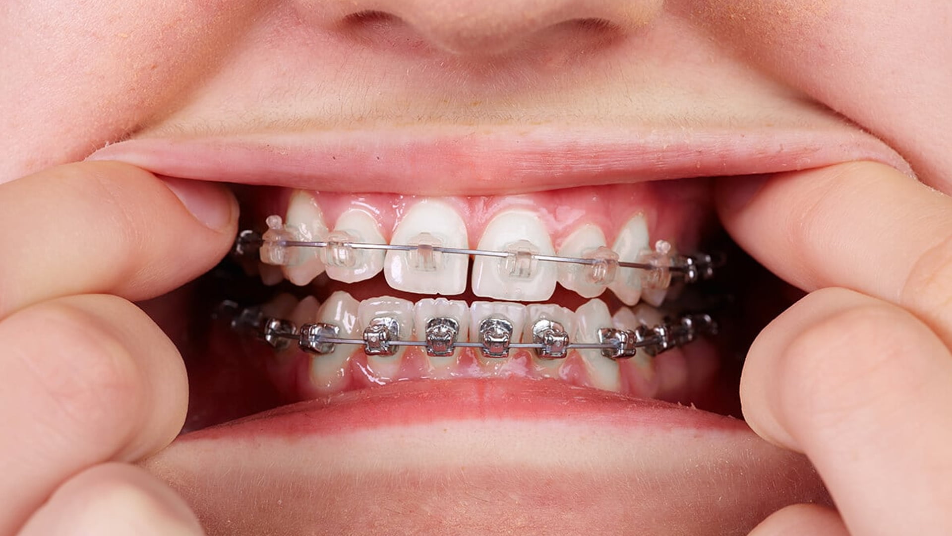 Understanding Everything About Ceramic Braces