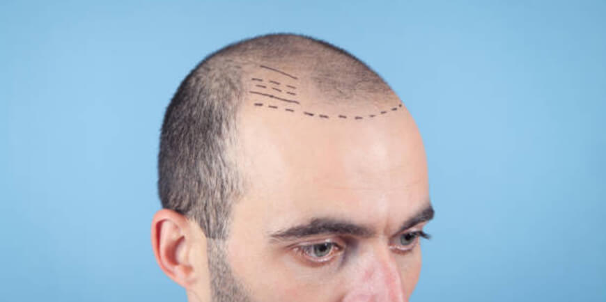 Hair Transplants in Bogotá: A Hub of Innovation and Transformation