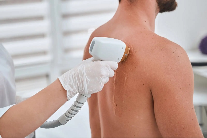 Laser Back Hair Removal: Is It Worth the Investment?