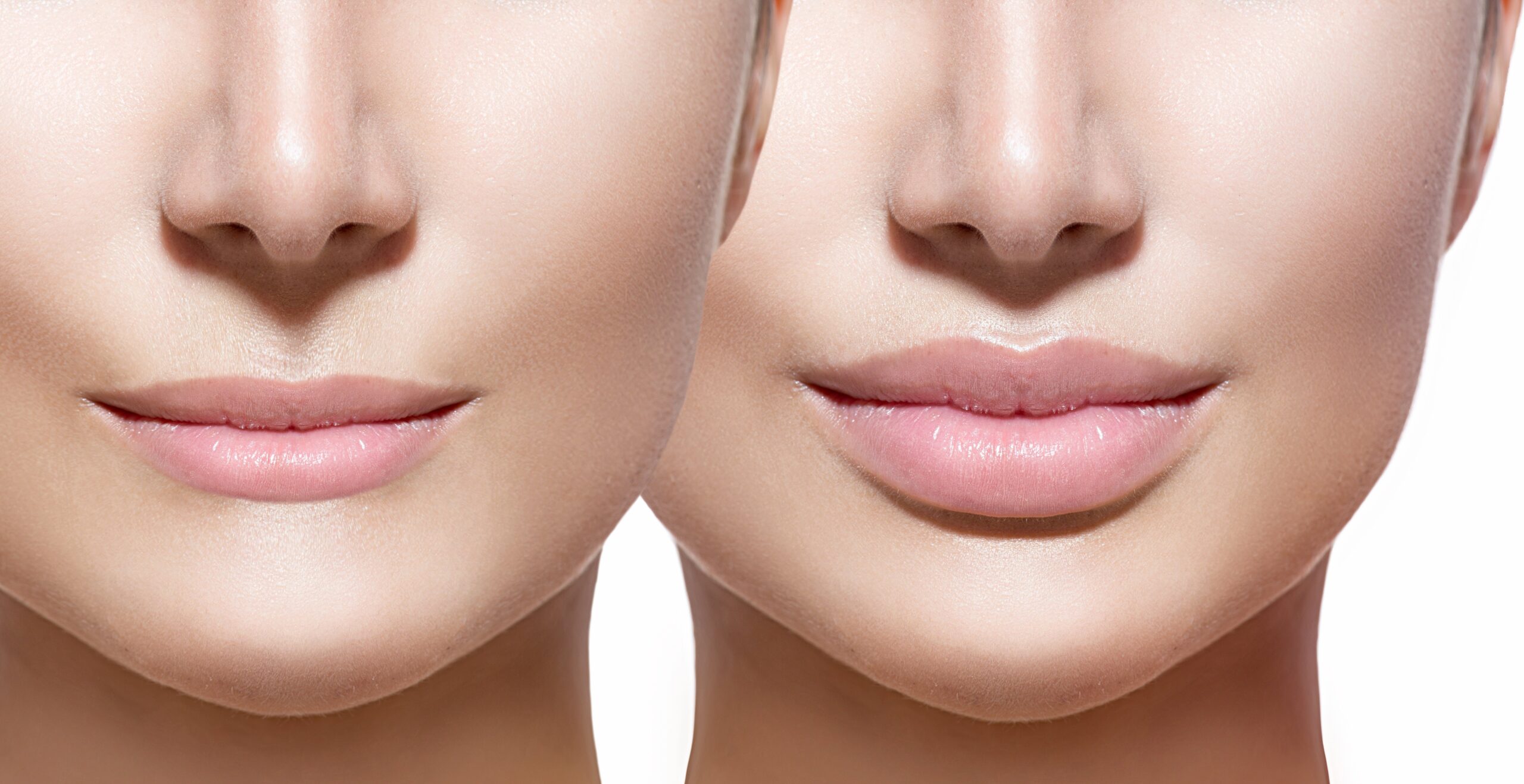How to Restore Volume and Smooth Wrinkles with Lip Fillers